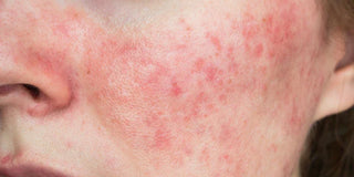 Couperose visage : nos 7 conseils pour réduire et apaiser durablement ses rougeurs