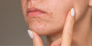 Dermatite périorale et rougeurs autour de la bouche : ce que vous auriez aimé savoir dès le début