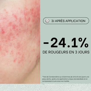 reduction-des-rougeurs-routine-anti-rougeurs-rosacee