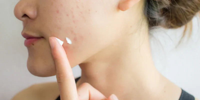 Acné, comment éviter l'effet rebond après l'été ?