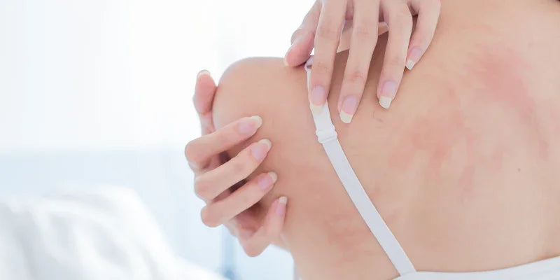 Comprendre l'eczéma: causes, symptômes et traitements efficaces
