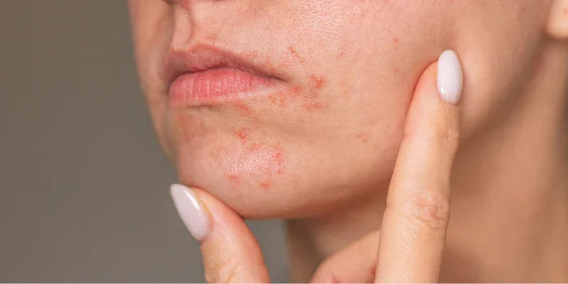 Dermatite périorale et rougeurs autour de la bouche : ce que vous auriez aimé savoir dès le début