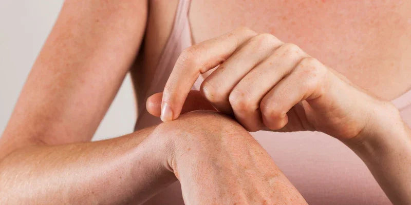 Eczéma nerveux : causes, symptômes et solutions naturelles pour en venir à bout