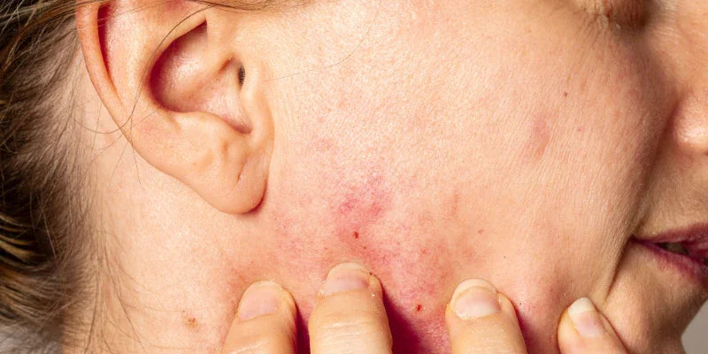 Eczéma du visage : comment le soigner naturellement ?