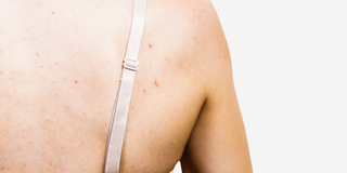 Peau : d'un dysfonctionnement à l'eczéma