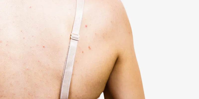 Peau : d'un dysfonctionnement à l'eczéma