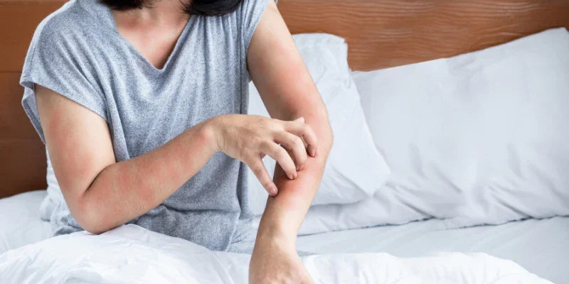Effet rebond post été : L'eczéma et les changements de saison
