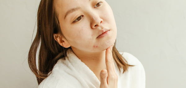 Effet rebond acne