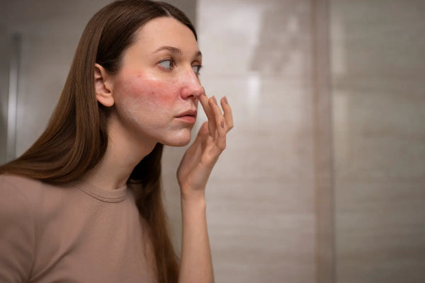 Tout savoir sur l'inflammation de la peau : causes, symptômes et solutions naturelles