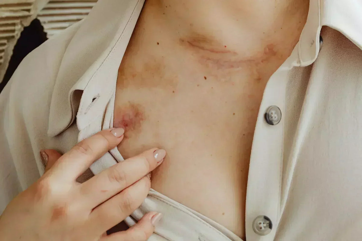 Eczéma nummulaire : signes, facteurs et solutions
