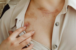 Eczéma nummulaire : signes, facteurs et solutions