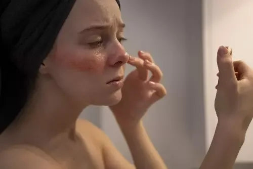 Rougeurs : les comprendre et les atténuer avec des soins adaptés