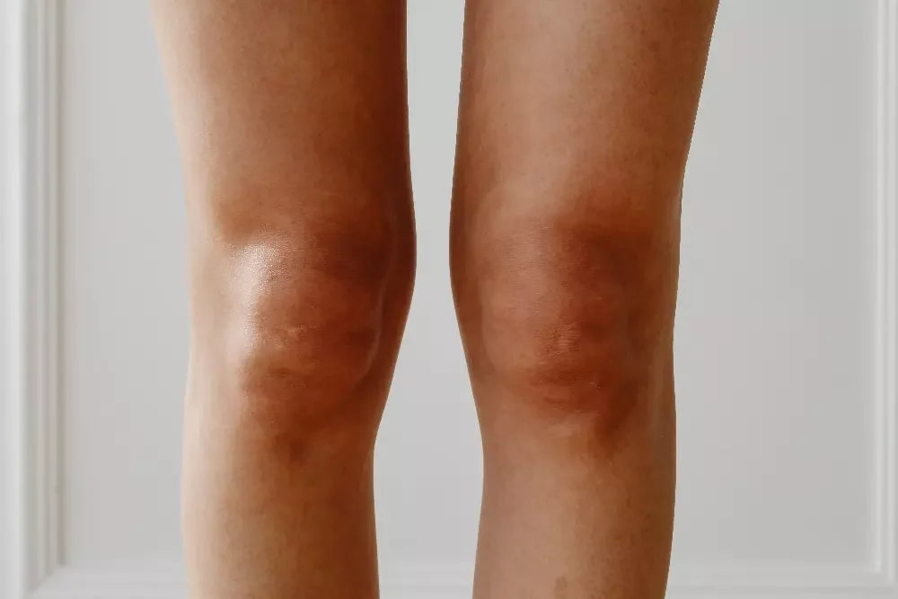 Eczéma variqueux : causes, symptômes et solutions pour apaiser la peau