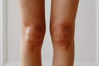Eczéma variqueux ou eczéma des jambes : tout savoir sur cette affection cutanée