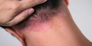 Psoriasis du cuir chevelu : reconnaître les symptômes et soulager les plaques naturellement