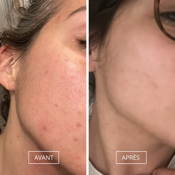 Routine peau atopique et crème eczéma