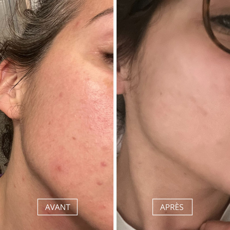 Soin peau atopique et crème eczéma
