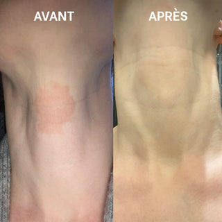 Avant / après de l'application de la Cold cream SOS rougeurs et démangeaisons Réjence sur une plaque d'eczéma au niveau du cou, avec une diminution visible des rougeurs.