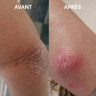 Avant / après de l'utilisation de la Crème riche SOS sécheresses et squames Réjence montrant une amélioration visible d'une peau très sèche et squameuse au niveau du coude.