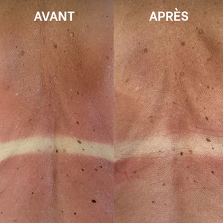 Comparatif avant/après montrant un coup de soleil sur le dos réduit et apaisé en moins de 14h.