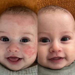 Avant après de l'eczéma d'un bébé