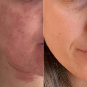 Avant après d'une peau sujette à l'eczéma
