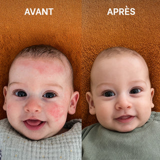 Avant / après du Gel-crème hydratant bébé Réjence montrant une amélioration visible des rougeurs et de l'hydratation de la peau d'un bébé.