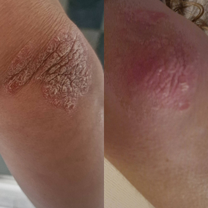 Avant après de plaques de psoriasis sur le coude