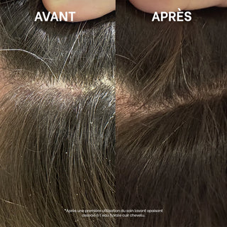Comparatif avant/après du cuir chevelu montrant une nette diminution des pellicules et squames après une première utilisation du Soin Lavant Apaisant et de l'Eau Florale Cuir Chevelu Réjence.