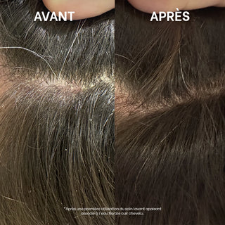 Avant/après d'un cuir chevelu atteint de dermite séborrhéique montrant une diminution visible des squames après une première utilisation.