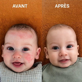 Comparaison avant et après du visage d'un bébé présentant des rougeurs liées à l'eczéma atopique, montrant une peau visiblement plus apaisée après utilisation de la routine Réjence.