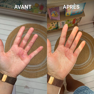 Avant / après de la routine SOS eczéma atopique Réjence montrant une amélioration visible d'une peau sèche et irritée au niveau de la main.