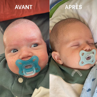 Comparaison avant et après d'un bébé présentant des rougeurs et des plaques d'eczéma sur le visage, montrant une peau visiblement apaisée après utilisation de la routine SOS eczéma bébé Réjence.