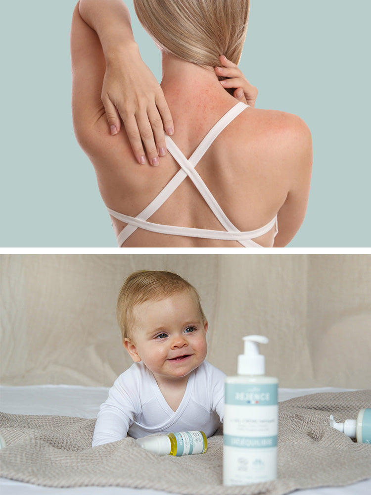 Peau atopique et eczéma