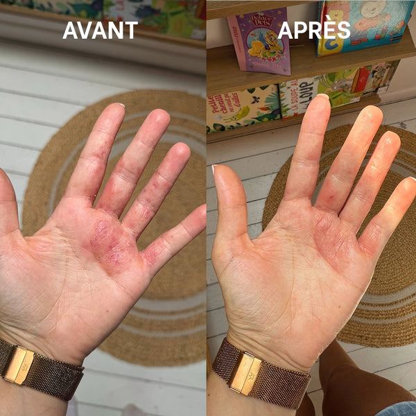Routine complète eczéma